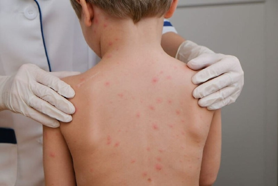 Três casos de meningite viral fazem cidade de MT suspender aulas